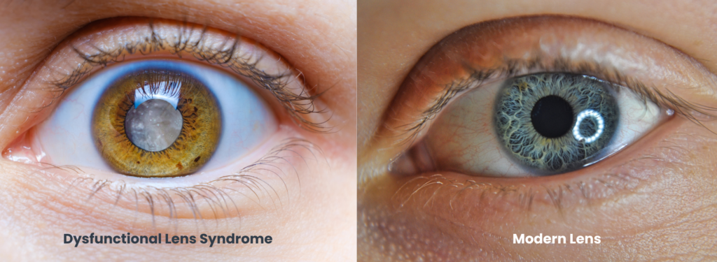 A side-by-side illustration of a natural lens affected by Dysfunctional Lens Syndrome vs. a modern lens after CLR